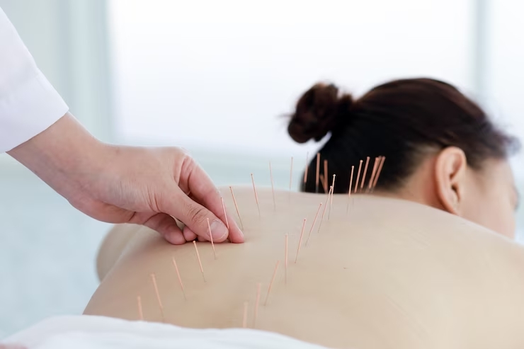 Acupuncture